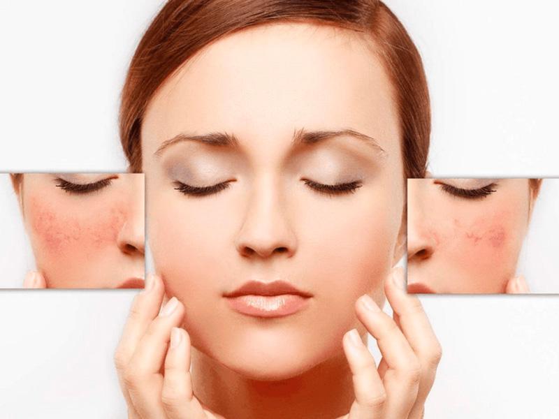 Công dụng Madecassoside giúp làm giảm dị ứng, mẩn đỏ hiệu quả