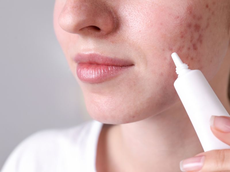 Algin hỗ trợ điều trị mụn hiệu quả