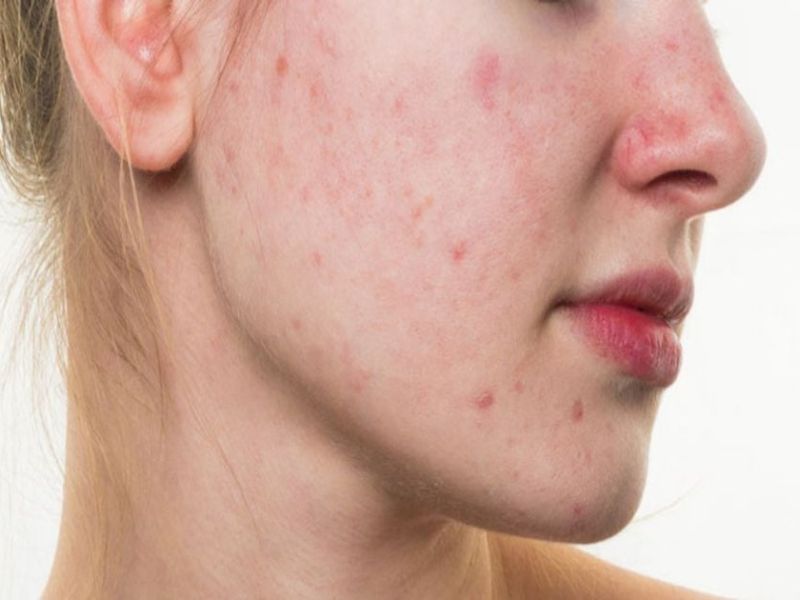 Papain giúp kiểm soát sự phát triển của vi khuẩn gây mụn